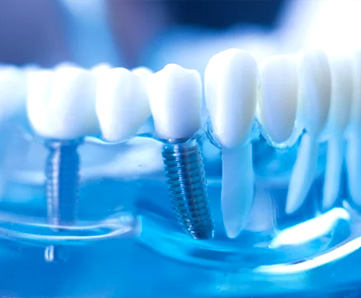 Implant Surgery