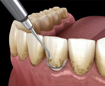 Peridental
